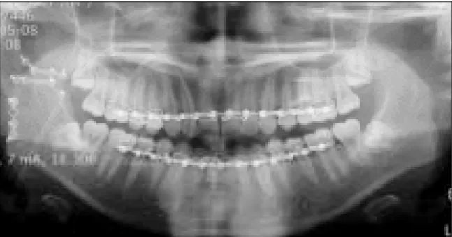 Table 2.  The state of occlusion-articulating paper  Table 3.  Maximum opening 