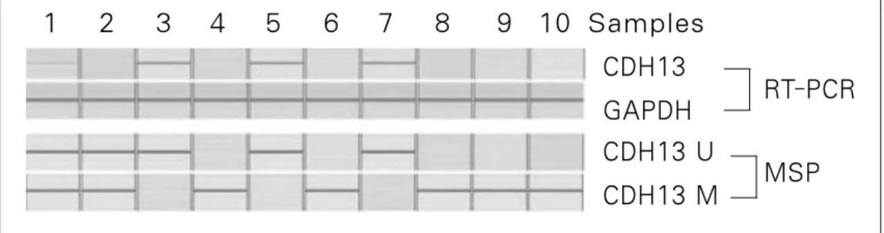 Fig. 5. T-cadherin(CDH-13)  gene  expression  after  RT-PCR  &amp;  promoter  methylation  specific  PCR  of  #1-#10 samples(U: unmethylation, M: methylation, MSP: methylation specific PCR)