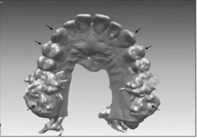 Fig. 5. The second registration step by the surface based fusion of digital dental model and 3D skull model