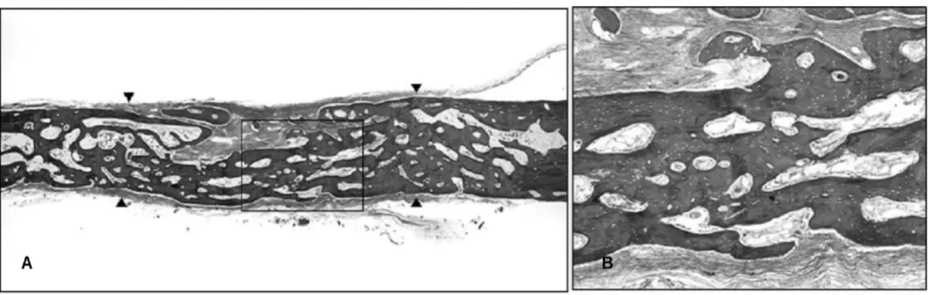 Fig. 5. Defect  grafted  with  harvested  autogenous  bone  particles  using  a  piezosurgery  at  6th  week