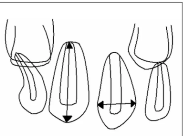 Fig. 2. Angle of supernumerary tooth.