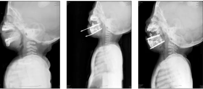 Fig. 6. Neck  soft  tissue  radiographs  at  the  preoperative (left), immediate  postdistraction  (center),  and  postdis- postdis-traction 4 months (right)