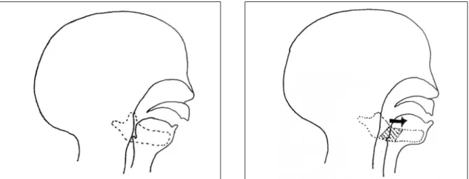 Fig. 8. Diagrams of a preoperative neonate with micrognathia and airway obstruction at the level of the tongue base and supraglottic structures (left), and a postoperative neonate having osteogenesis of the mandible after distraction