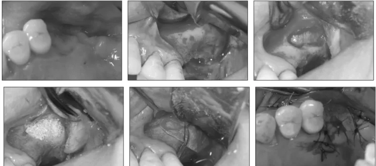 Fig. 1. Surgical procedures of sinus bone grafts using deprotenized bovine bones.