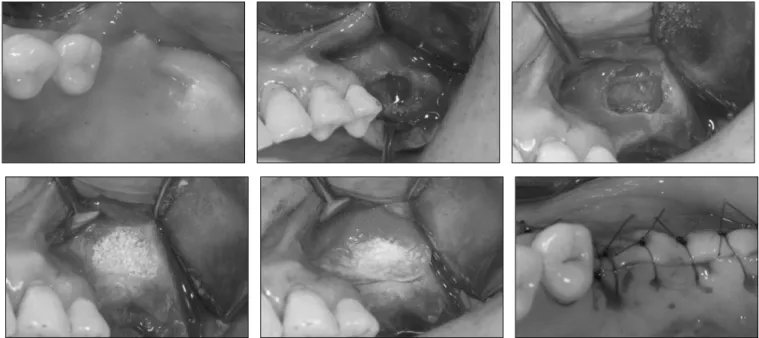 Fig. 2. Surgical procedures of sinus bone grafts using beta tricalcium phosphate.