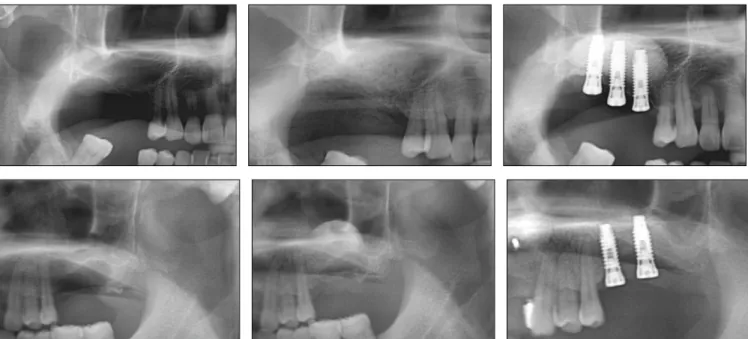 Fig. 5. Radiographic  changes  of  grafted  sinuses  after  using  DBBM  (upper)  and  TCP  (lower)  before  (left),  immediately  after (middle), and 6 months after (right) sinus bone grafts.