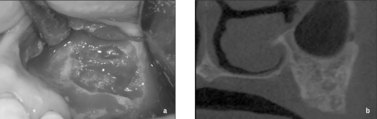 Fig. 1. The artery on sinus lateral wall. (a) Clinical view after the formation of lateral bone wall (b) Computed topographic image of the case