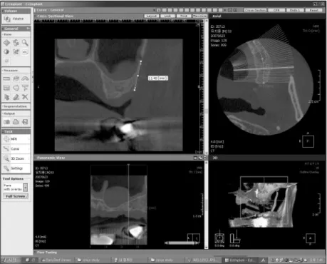 Fig. 2. Determining  the  distance  between  the  alveolar  crest  and  artery  on sinus lateral wall with computed topography