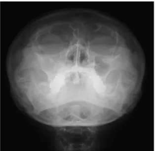 Fig. 1. preoperative Waters’view showed haziness in right maxillary sinus (case 1).