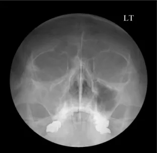 Fig. 7. 4  months  postoperative  CT  coronal  view showed clearness in right maxillary sinus (case 2).