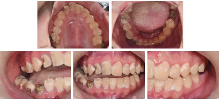 Fig. 1. Intra-oral photos of first case at initial visit.