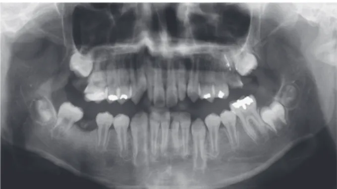 Fig. 6. Intra-oral photos of second case. (A) Regular follow up check in march 2018. (B) After applications of SDF for arresting  caries at the same day.