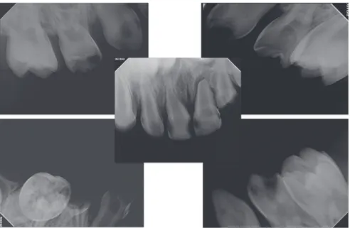 Fig. 2. Pre-treatment intraoral radiograph (Before #61 extraction).
