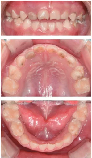 Fig. 4. Intraoral photos after treatment under general anesthesia. 예후가 불량하다고 판단되어 발거를 시행하였으며, 발거한 치아는 치근 외흡수와 함께 평활면 우식 및 부식의 양상을 보였다 (Fig