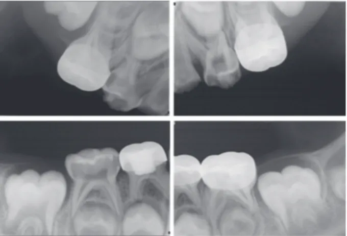 Fig. 1. Intraoral radiograph before treatment.