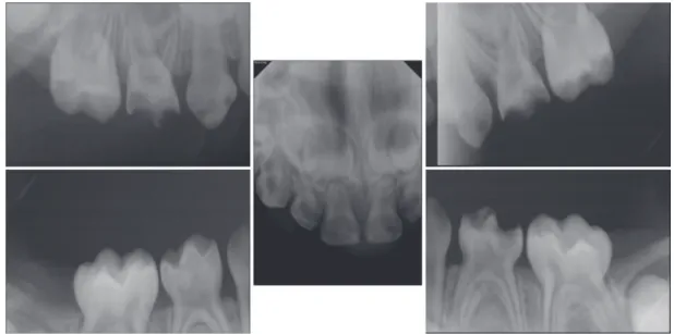 Fig. 1. Intraoral radiograph before treatment.