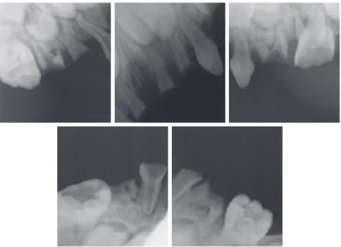 Fig. 1. Intraoral radiograph before treatment.