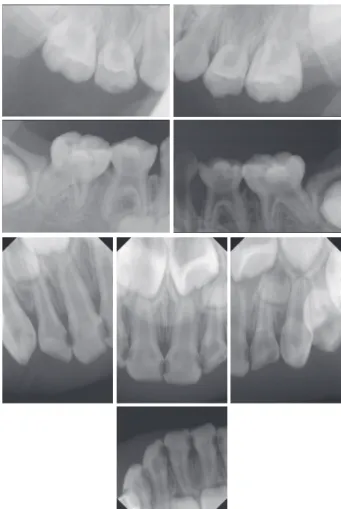 Fig. 1. Intraoral radiograph before treatment.