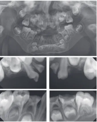 Fig. 1. Extraoral photo shows micrognathia.