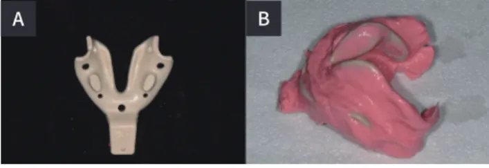 Fig. 3.  (A) Adjusted frame cut back tray, (B) Preliminary  mandibular impression.