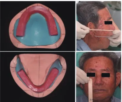 Fig. 6.  Fabrication of record bases with  occlusion rims and determination of  vertical dimension of occlusion.