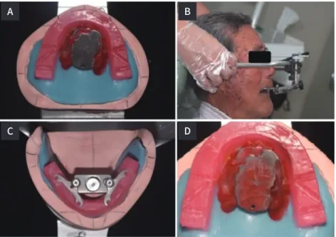 Fig. 7.   Gothic arch tracing using BioCR.  (A) Attachment of tracing plate on maxillary  record base, (B) Facebow transfer, (C)  Attachment of tracing pin on mandibular  wax rim, (D) Gothic arch tracing for CR  record.