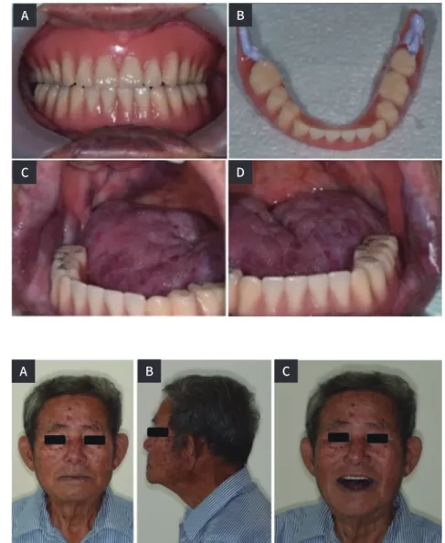 Fig. 8.   Definitive complete dentures.  (A) Frontal view, (B) BTC point on Rt  and Lt retromolar pads, (C) Right side  of mandibular denture, (D) Left side of  mandibular denture.