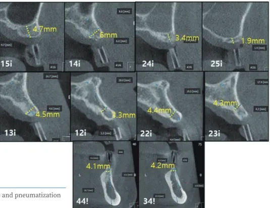 Fig. 7.  CBCT images. A narrow ridge and pneumatization  of the maxilla was observed.