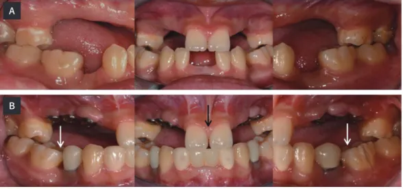 Fig. 9.  Orthodontic relapse. (A) Before treatment, (B) After 2 nd  surgery of maxillary implants