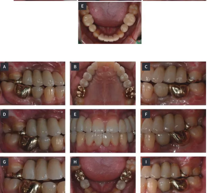 Fig. 11.  Definitive prosthesis. (A) Working side during right lateral excursion, (B) Maxillary occlusal view, (C) Balancing side  during right lateral excursion, (D) Left lateral view at centric occlusion, (E) Frontal view at centric occlusion, (F) Right 