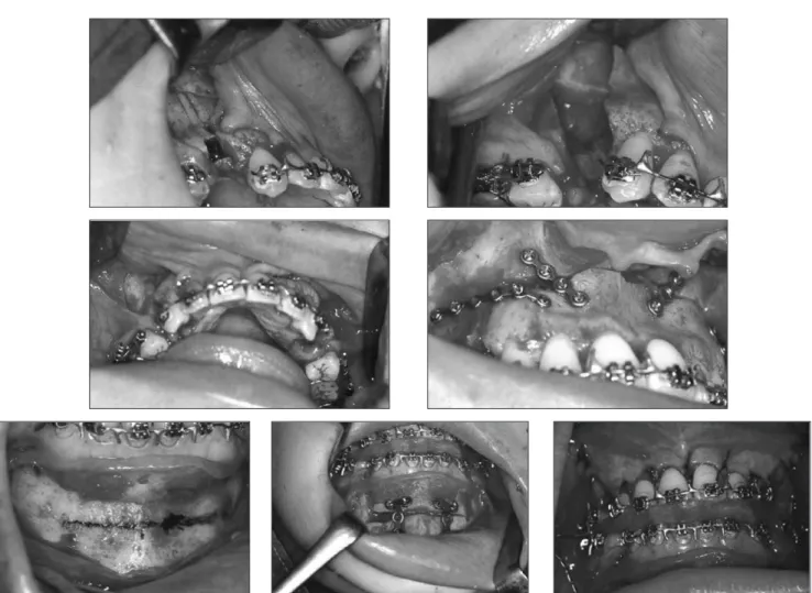 Fig. 3. Anterior Segmental Osteotomy surgery in maxilla and mandible.