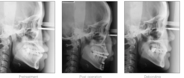 Fig. 6. Pre-treatment, post-treatment cephalometric changes.