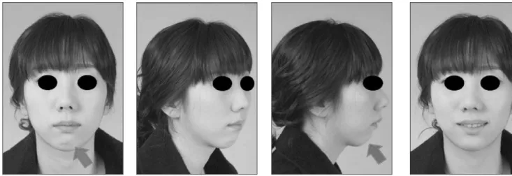 Fig. 12. Extraoral photo - 28 months after debonding.