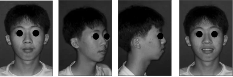 Fig. 1. Pretreatment Extraoral photos 