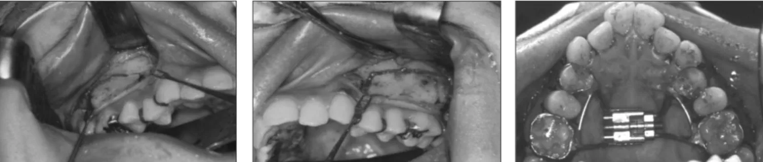 Fig. 5. Buccal and palatal corticotomy of the maxilla was performed and hyrax screw was applied.