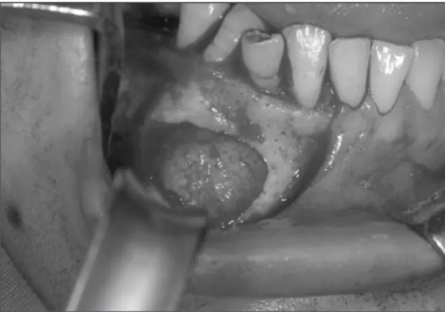 Fig. 6. Operation intraoral photograph after bone graft with ramal bone and Bio-oss � .