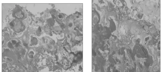 Fig. 10. Photomicrograph showing sheets of ghost cell with area of calcification.