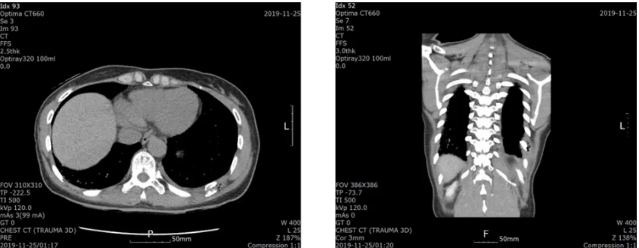 Fig. 1. Chest Computed Tomography(CT). Chest CT shows broken 9th rib and hemopneumothorax in the left posterior 