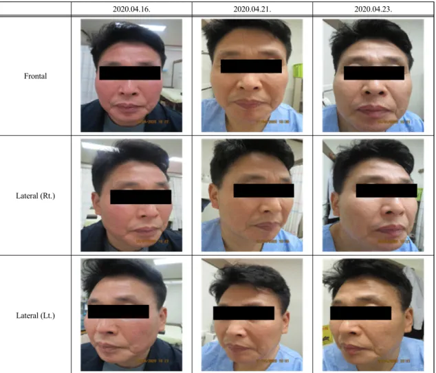 Fig.  2.  Clinical  Progress  of  Rosacea