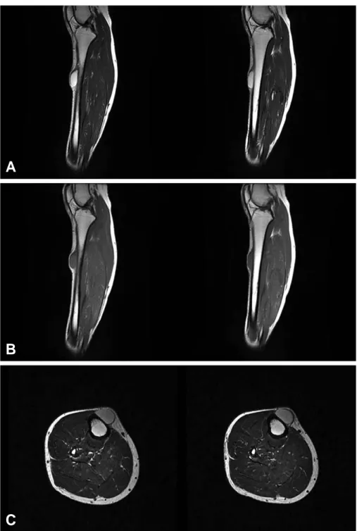 Fig. 3. MRI findings show ovoid mass-like lesion at anterior aspect of the proximal tibia with high signal intensity