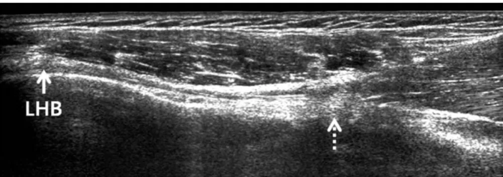 Fig. 3. Long axis image of the long head of biceps tendon (arrow) showing the musculotendinous junction (dotted