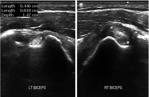 Fig. 8. Short axis image of the long head of the biceps tendon showing a difference between both shoulders
