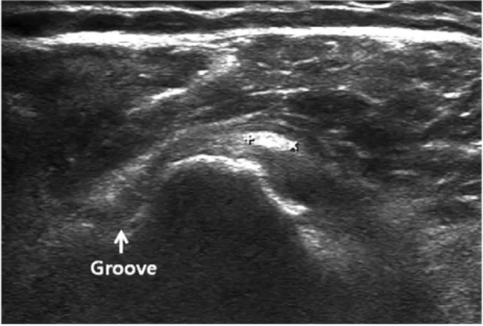 Fig. 12. Short axis image at the bicipital groove level