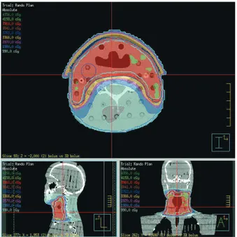 Fig. 7.  Commercial	Bolus	Plan	Image	(A)	and	3D	Bolus	 Plan	Image	(B) Table 2.  Dose	Constraints	for	Hypopharynx	Cancer	VMAT	 Planning Organ Constraint PTV D95 &gt; Prescription dose(Gy) P_Cord Vmax &lt; 27.2 Gy Brainstem Vmax &lt; 29.0 Gy Brain Vmax &lt; 