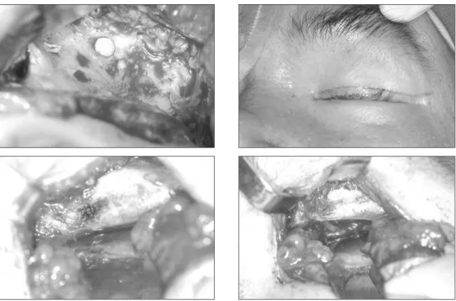 Fig. 2. Infraorbital and supraorbital nerve were excised. Infraorbital neurectomy was done through vestibular approach and infraorbital foramen was obturated with bone block