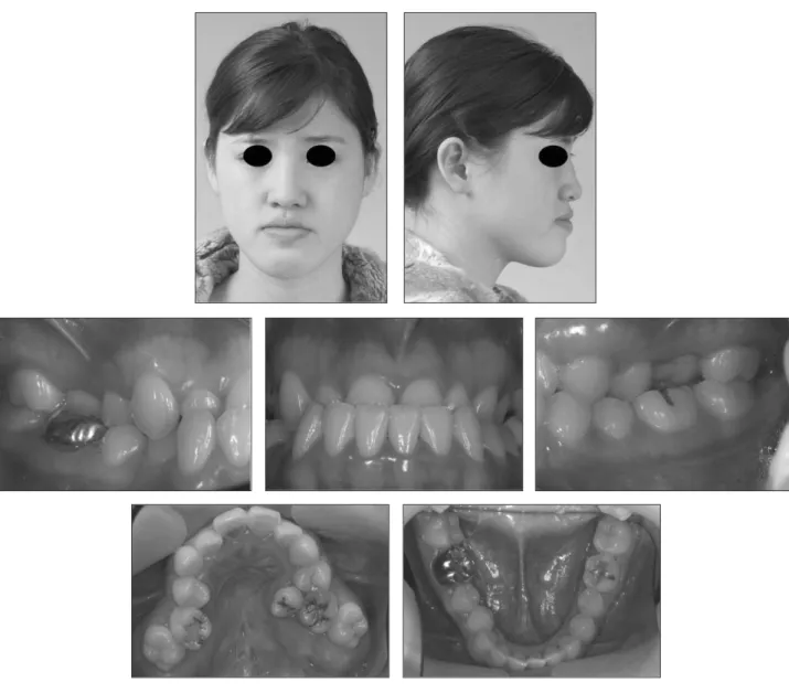 Fig. 1. Initial extraoral and intraoral photos.
