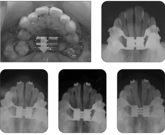 Fig. 5. Expansion of maxilla.