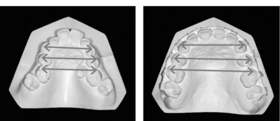 Table 1. Cephalometric measurements of initial, after SARPE and after BSSRO