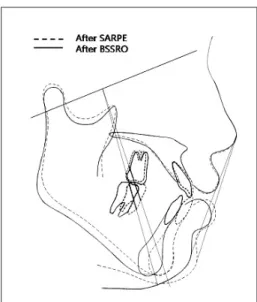Fig. 12. Superimposition of initial and after SARPE. Fig. 13. Superimposition of after SARPE and after BSSRO.