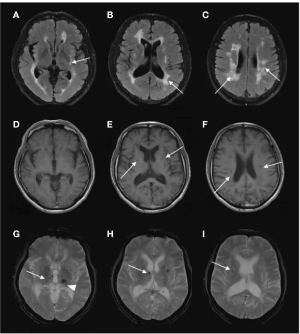 Figure 1.  Brain MRI of the first CADASIL patient diagnosed in Jeju. FLAIR (fluid attenuated inversion recovery) images (A,B, and C) show 